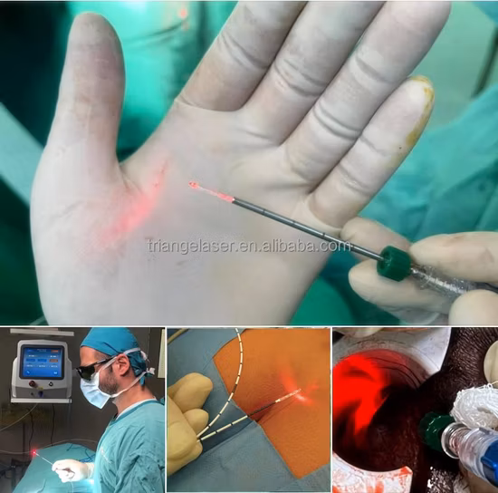 Dispositivo láser Endolift de lipólisis láser Triangel 980nm 1470nm con máquina de elevación facial de cirugía láser de liposucción CE médica